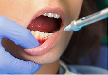 Novocaine used at the dentists