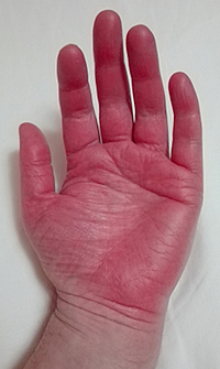 Red hands due to Erythromelalgia
